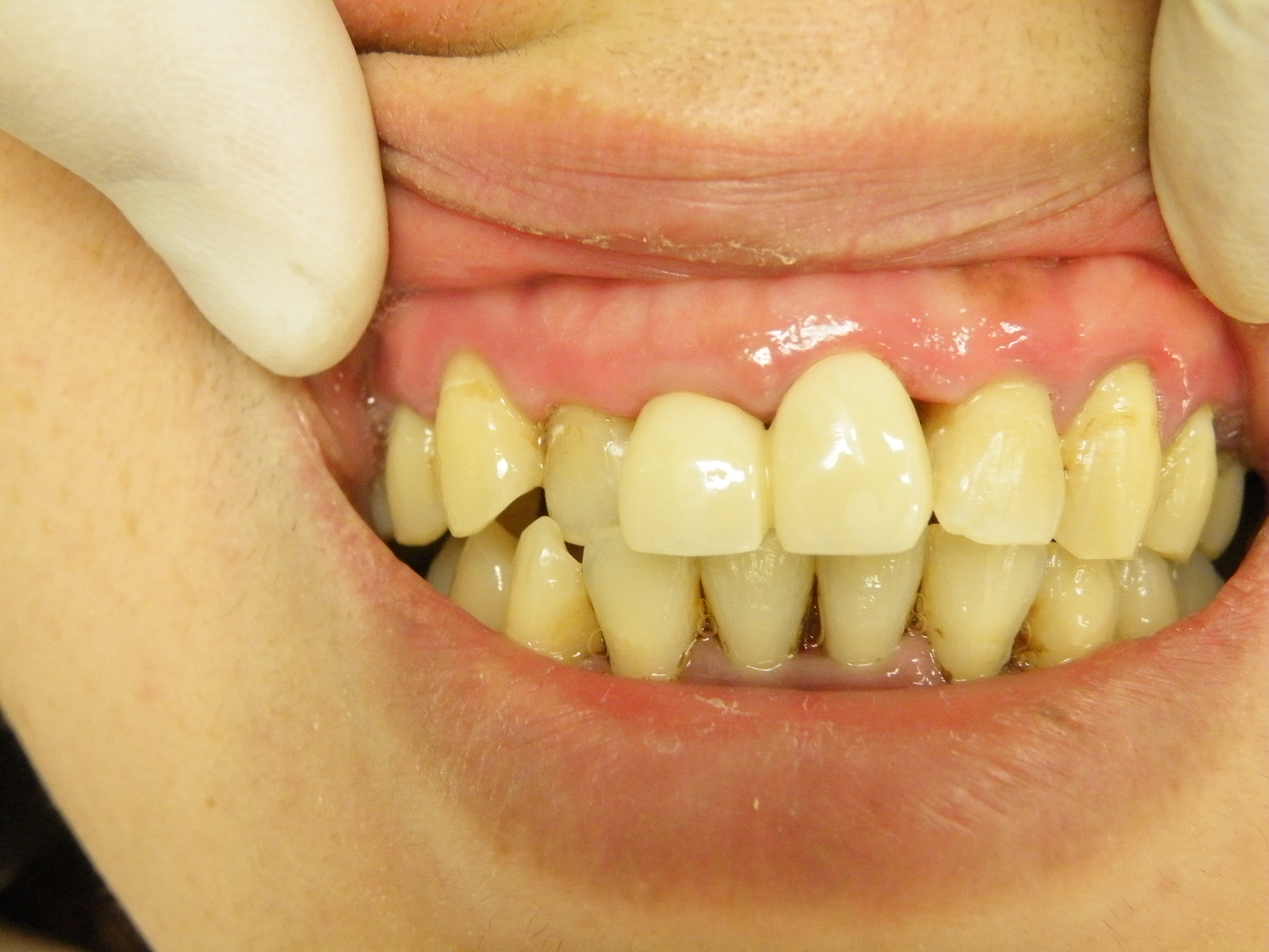 インプラント 以外 の 方法 前歯