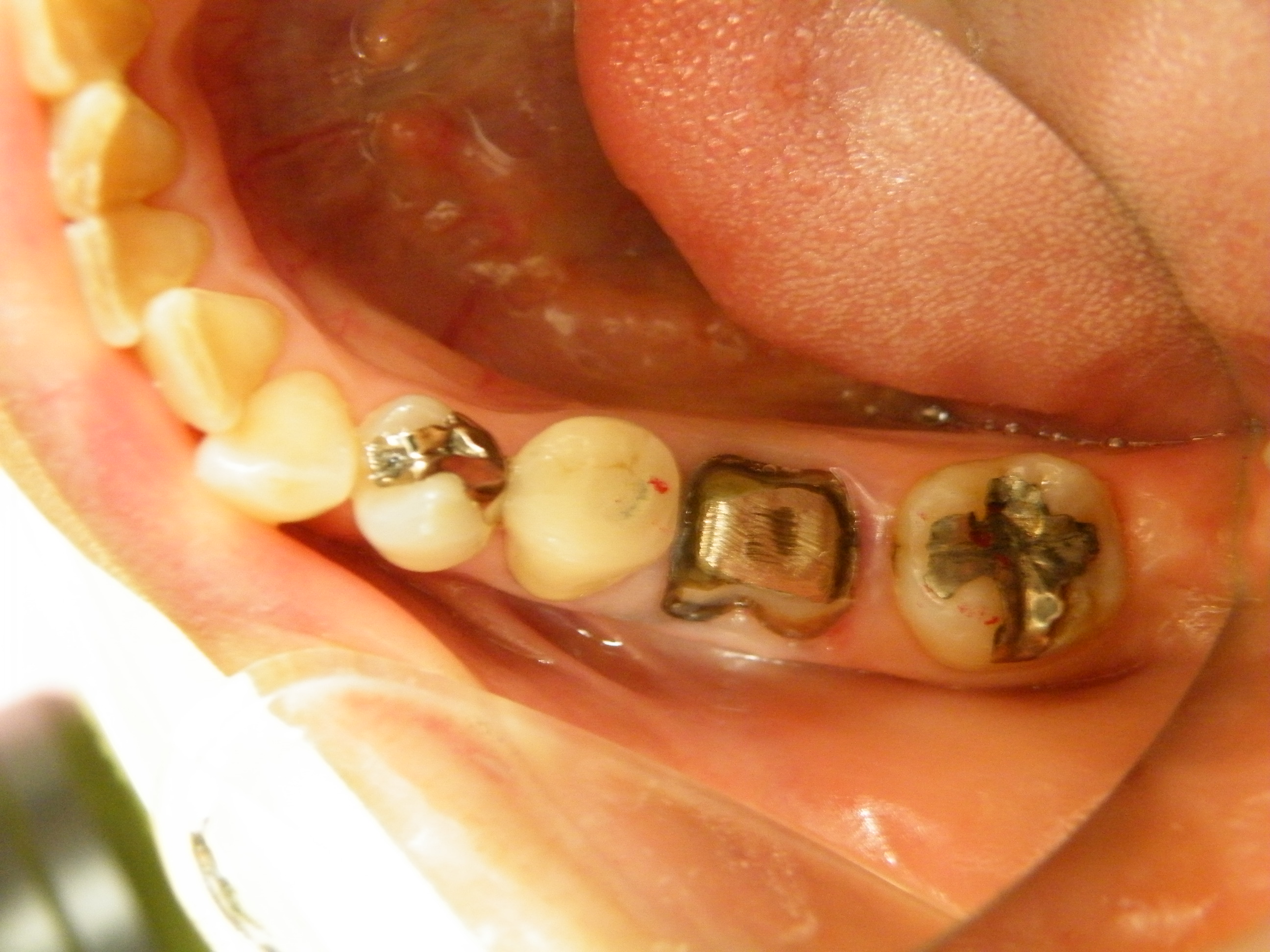奥歯 の 被せ 物