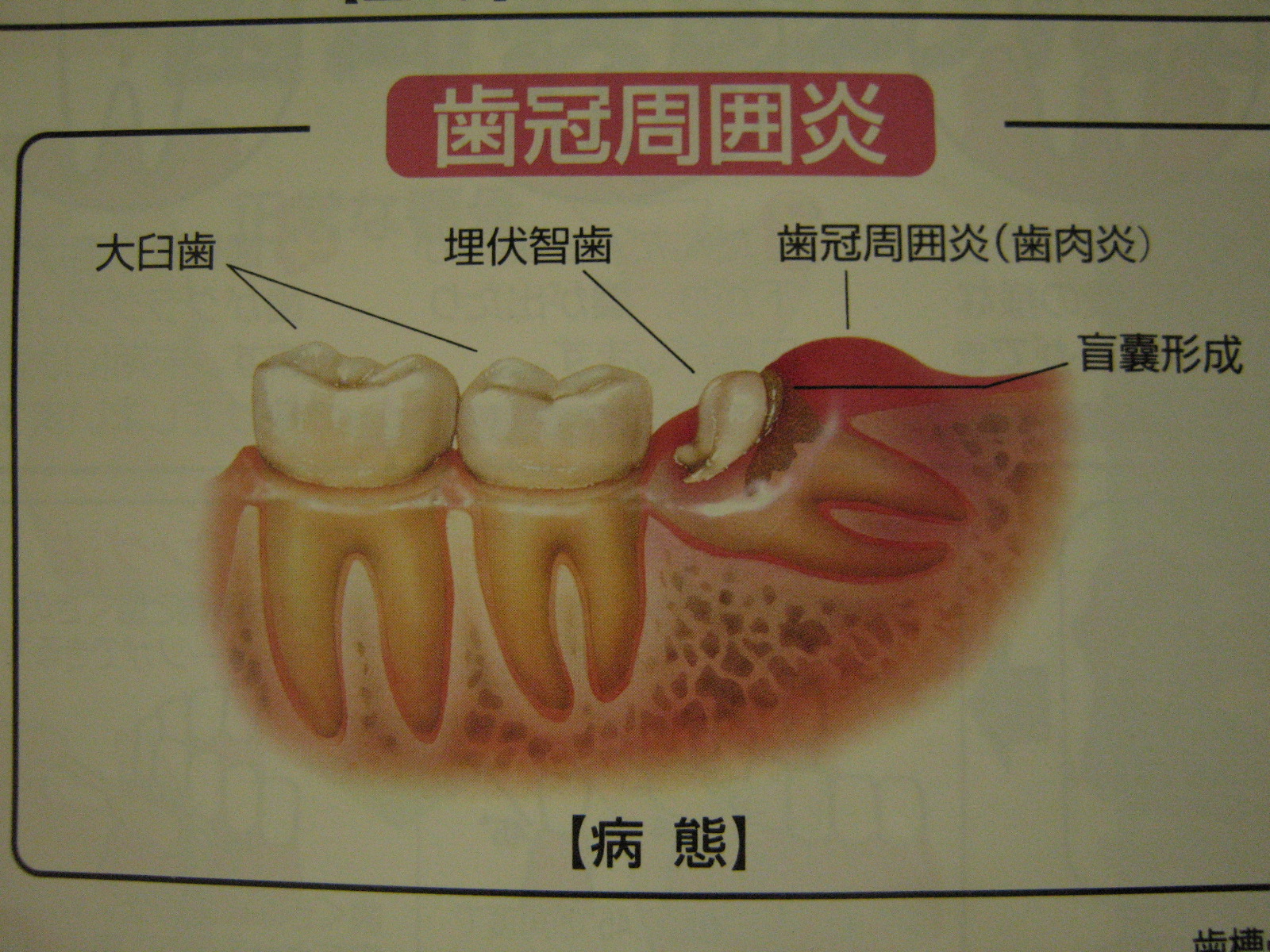 の 匂い 虫歯