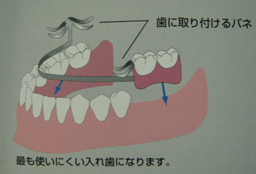 入れ歯の利点、欠点は？