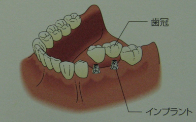 インプラント治療