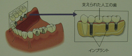 インプラントブリッジで治療