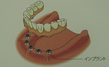 インプラント治療