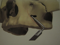臼歯部のドリリング