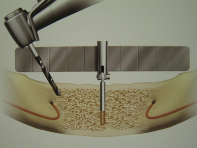 臼歯部の形成