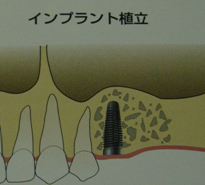 サイナスリフト