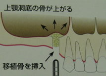 サイナスリフト